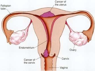 Cancerul uterin